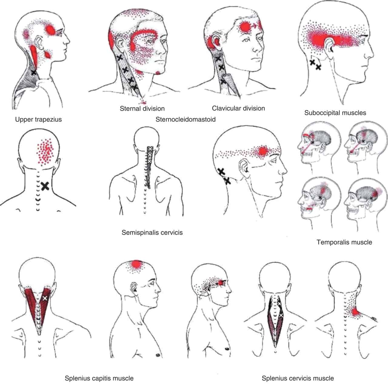 Albums 94+ Pictures Types Of Headaches And Location With Pictures Stunning