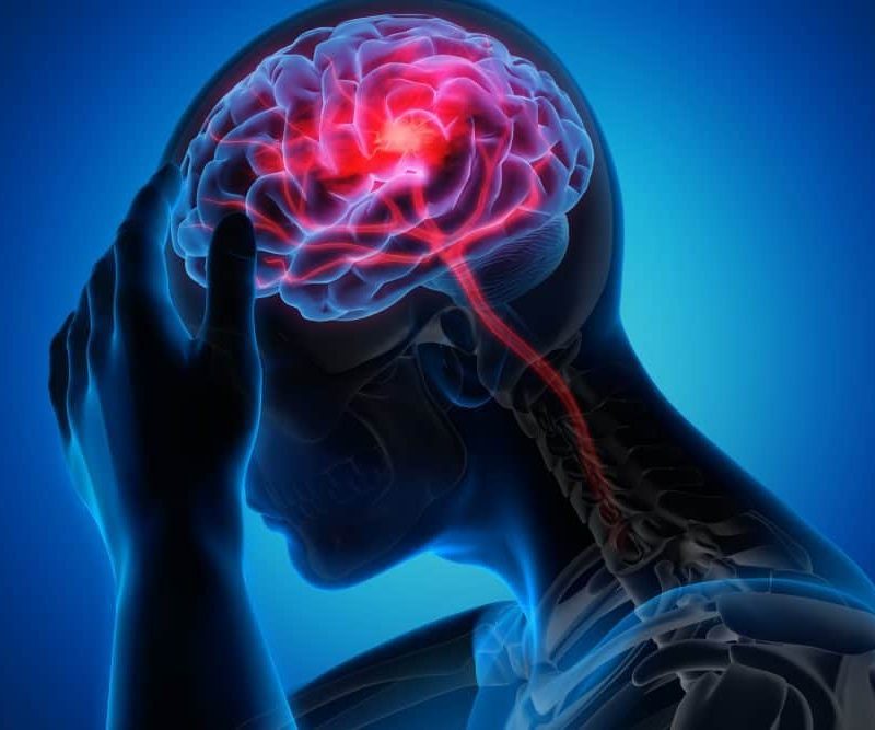 Migraine Image
