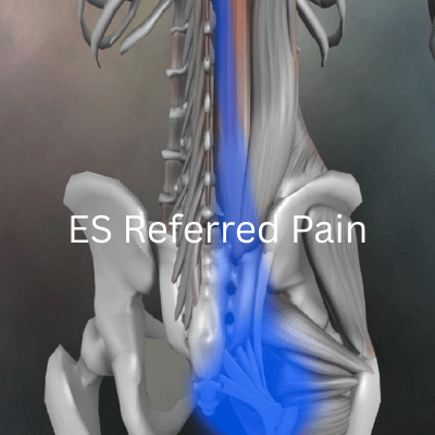 ES Referred Pain