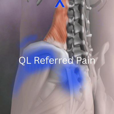 QL Referred Pain